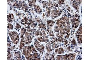 Immunohistochemical staining of paraffin-embedded Carcinoma of liver tissue using anti-PPME1mouse monoclonal antibody. (PPME1 抗体)
