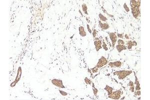 This antibody stained formalin-fixed, paraffin-embedded sections of human breast invasive ductal carcinoma. (WNT3A 抗体)