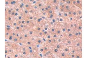 IHC-P analysis of Human Liver cancer Tissue, with DAB staining. (IL13 Receptor alpha 1 抗体  (AA 203-376))