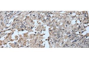 Immunohistochemistry of paraffin-embedded Human lung cancer tissue using UBR2 Polyclonal Antibody at dilution of 1:55(x200) (UBR2 抗体)