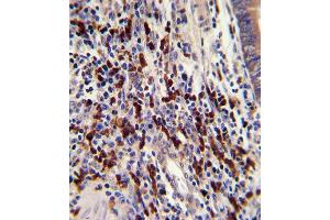 Formalin-fixed and paraffin-embedded human colon carcinoma with CNOT8 Antibody (C-term), which was peroxidase-conjugated to the secondary antibody, followed by DAB staining. (CNOT8 抗体  (C-Term))