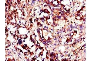 Immunohistochemistry of paraffin-embedded human gastric cancer using ABIN7174080 at dilution of 1:100 (YES1 抗体  (AA 1-155))