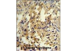 U antibody (C-term) (ABIN654948 and ABIN2844589) immunohistochemistry analysis in formalin fixed and paraffin embedded human kidney carcinoma followed by peroxidase conjugation of the secondary antibody and DAB staining. (UPP2 抗体  (C-Term))