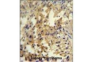 U antibody (C-term) (ABIN654948 and ABIN2844589) immunohistochemistry analysis in formalin fixed and paraffin embedded human kidney carcinoma followed by peroxidase conjugation of the secondary antibody and DAB staining. (UPP2 抗体  (C-Term))