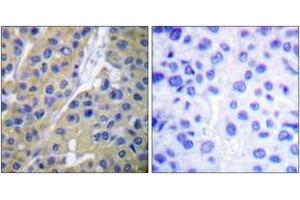 Immunohistochemistry analysis of paraffin-embedded human breast carcinoma, using Keratin 18 (Phospho-Ser33) Antibody. (Cytokeratin 18 抗体  (pSer34))