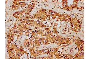 IHC image of nforHU diluted at 1:20 and staining in paraffin-embedded human liver cancer performed on a Leica BondTM system. (HIST1H1E 抗体  (AA 57-69))