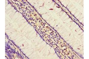 Immunohistochemistry of paraffin-embedded human colon cancer using ABIN7170709 at dilution of 1: 100 (STARD9 抗体  (AA 1960-2180))