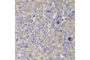 Immunohistochemistry of paraffin-embedded mouse cancer using HSPA14 antibody at dilution of 1:100 (x400 lens). (HSPA14 抗体)