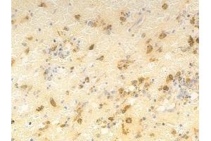 ABIN6261673 and ABIN6276895 at 1/100 staining human melanoma by IHC-P. (FANCC 抗体  (N-Term))