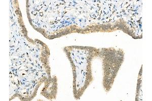 Phospho-YY1 (Ser365) Antibody at 1/100 staining Human ovarian cancer by IHC-P. (YY1 抗体  (pSer365))