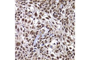 Immunohistochemistry of paraffin-embedded human well-differentiated squamous skin carcinoma using DNAJB6 antibody (ABIN5974242) at dilution of 1/100 (40x lens). (DNAJB6 抗体)