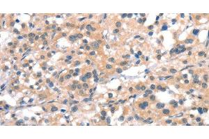 Immunohistochemistry of paraffin-embedded Human thyroid cancer tissue using CYP2D6 Polyclonal Antibody at dilution 1:40 (CYP2D6 抗体)