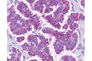 Anti-SMO / Smoothened antibody IHC of human Ovary, Carcinoma. (SMO 抗体  (1st Extracellular Domain))