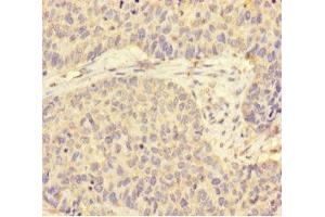 Immunohistochemistry of paraffin-embedded human ovarian cancer using ABIN7170819 at dilution of 1:100 (STIP1 抗体  (AA 1-543))