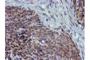 Immunohistochemical staining of paraffin-embedded Adenocarcinoma of Human breast tissue using anti-ALOX15 mouse monoclonal antibody. (ALOX15 抗体)