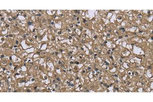 Immunohistochemistry of paraffin-embedded Human prostate cancer using FBP1 Polyclonal Antibody at dilution of 1:40 (FBP1 抗体)