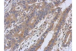 IHC-P Image Immunohistochemical analysis of paraffin-embedded human colon carcinoma, using PKC alpha, antibody at 1:500 dilution. (PKC alpha 抗体  (N-Term))