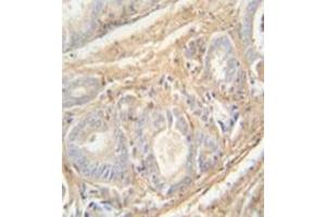 Immunohistochemistry analysis in formalin fixed and paraffin embedded human prostate carcinoma reacted with PCOTH Antibody (Center) followed by peroxidase conjugation of the secondary antibody and DAB staining. (PCOTH 抗体  (Middle Region))