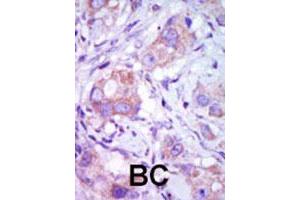 Formalin-fixed and paraffin-embedded human cancer tissue reacted with the MAP3K9 polyclonal antibody  , which was peroxidase-conjugated to the secondary antibody, followed by DAB staining. (MAP3K9 抗体  (C-Term))