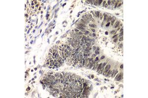 Immunohistochemistry of paraffin-embedded human colon carcinoma using SMARCA4 antibody at dilution of 1:100 (x40 lens). (SMARCA4 抗体)