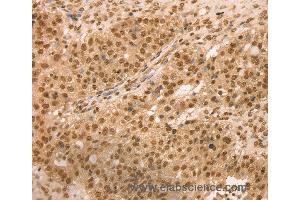 Immunohistochemistry of Human breast cancer using SNX8 Polyclonal Antibody at dilution of 1:25 (SNX8 抗体)