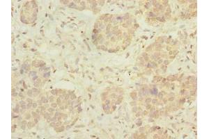 Immunohistochemistry of paraffin-embedded human gastric cancer using ABIN7175005 at dilution of 1:100 (MRPL46 抗体  (AA 28-153))