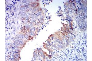 Immunohistochemical analysis of paraffin-embedded rectum cancer tissues using GRIA2 mouse mAb with DAB staining. (GRIA2 抗体  (AA 35-175))