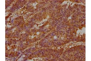 IHC image of ABIN7157186 diluted at 1:100 and staining in paraffin-embedded human colon cancer performed on a Leica BondTM system. (KALRN 抗体  (AA 2410-2661))