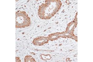 Immunohistochemistry of paraffin-embedded human breast cancer using ABCC5 antibody (ABIN6291734) at dilution of 1:100 (40x lens). (ABCC5 抗体)
