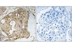 Immunohistochemistry analysis of paraffin-embedded human breast carcinoma, using p53 (Phospho-Ser366) Antibody. (p53 抗体  (pSer366))
