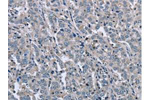 The image on the left is immunohistochemistry of paraffin-embedded Human liver cancer tissue using ABIN7129455(FAR2 Antibody) at dilution 1/50, on the right is treated with fusion protein.
