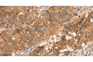 Immunohistochemistry of paraffin-embedded Human breast cancer using PDLIM4 Polyclonal Antibody at dilution of 1:30 (PDLIM4 抗体)