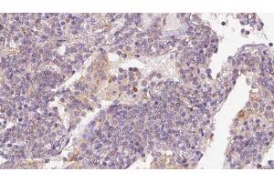 ABIN6273169 at 1/100 staining Human lymph cancer tissue by IHC-P. (STAU1/Staufen 抗体  (Internal Region))