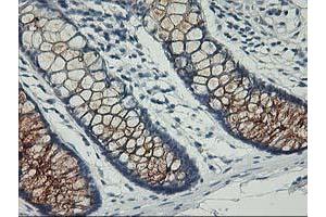 Immunohistochemical staining of paraffin-embedded Adenocarcinoma of Human ovary tissue using anti-PVRL1 mouse monoclonal antibody. (PVRL1 抗体)