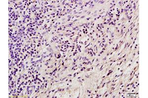 Formalin-fixed and paraffin embedded mouse tumor tissue labeled with Anti SORBS2 Polyclonal Antibody, Unconjugated (ABIN1387807) at 1:200 followed by conjugation to the secondary antibody and DAB staining (Sorbs2 抗体  (AA 401-500))