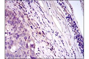 Immunohistochemical analysis of paraffin-embedded esophageal cancer tissues using CD33 mouse mAb with DAB staining. (CD33 抗体  (AA 15-237))