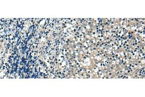 Immunohistochemistry of paraffin-embedded Human tonsil tissue using USP12 Polyclonal Antibody at dilution of 1:35(x200) (USP12 抗体)