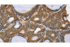 Immunohistochemistry of paraffin-embedded Human thyroid cancer using TRIM3 Polyclonal Antibody at dilution of 1:45 (TRIM3 抗体)