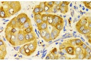 Immunohistochemistry of paraffin-embedded Human liver cancer using LRPAP1 Polyclonal Antibody at dilution of 1:100 (40x lens). (LRPAP1 抗体)
