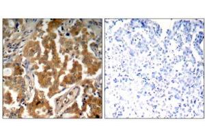 Immunohistochemical analysis of paraffin- embedded human lung carcinoma tissue using ADD1 (Phospho- Ser726) antibody (E011182). (alpha Adducin 抗体  (pSer726))
