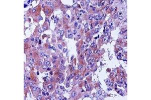 CD55 antibody immunohistochemistry analysis in formalin fixed and paraffin embedded human lung adenocarcinoma. (CD55 抗体  (AA 51-79))