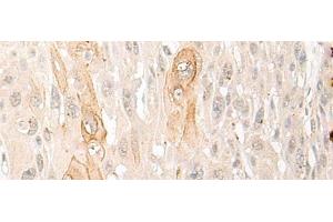 Immunohistochemistry of paraffin-embedded Human esophagus cancer tissue using DDX24 Polyclonal Antibody at dilution of 1:35(x200) (DDX24 抗体)