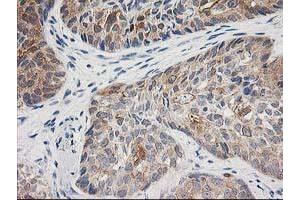 Immunohistochemical staining of paraffin-embedded Adenocarcinoma of Human breast tissue using anti-TOMM34 mouse monoclonal antibody.