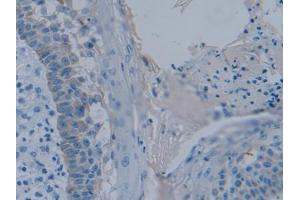 DAB staining on IHC-P; Samples: Human Skin cancer Tissue (PLAA 抗体  (AA 367-468))