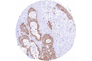 Pancreas Ductal adenocarcinoma with strong STING positivity of all tumor cells STING1 immunohistochemistry (STING1 (AA 190-290) 抗体)