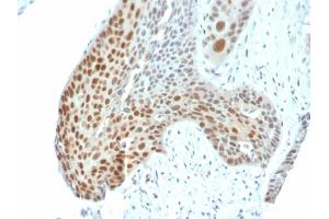 Formalin-fixed, paraffin-embedded human Cervical Tumor stained with Phospho c-Jun Mouse Monoclonal Antibody (C-J 4C4/1). (C-JUN 抗体)