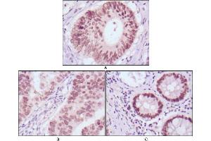 Immunohistochemical analysis of paraffin-embedded human colon cancer (A), gastric cancer (B) and rectal cancer (C) tissues using FOXA2 mouse mAb with DAB staining. (FOXA2 抗体)