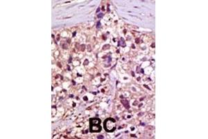 Formalin-fixed and paraffin-embedded human cancer tissue reacted with the primary antibody, which was peroxidase-conjugated to the secondary antibody, followed by AEC staining. (E1 Ubiquitin (AA 1026-1058), (C-Term) 抗体)