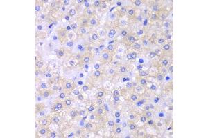 Immunohistochemistry of paraffin-embedded human liver cancer using SH2D1A antibody at dilution of 1:100 (400x lens). (SH2D1A 抗体)