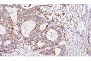 ABIN6273046 at 1/100 staining Human liver cancer tissue by IHC-P. (FAF2 抗体  (Internal Region))